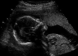 Normal ultrasound - 18 weeks pregnancy